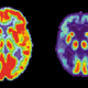 Illustration for article titled The First Evidence That Alzheimers Can Be Thwarted With A Pill